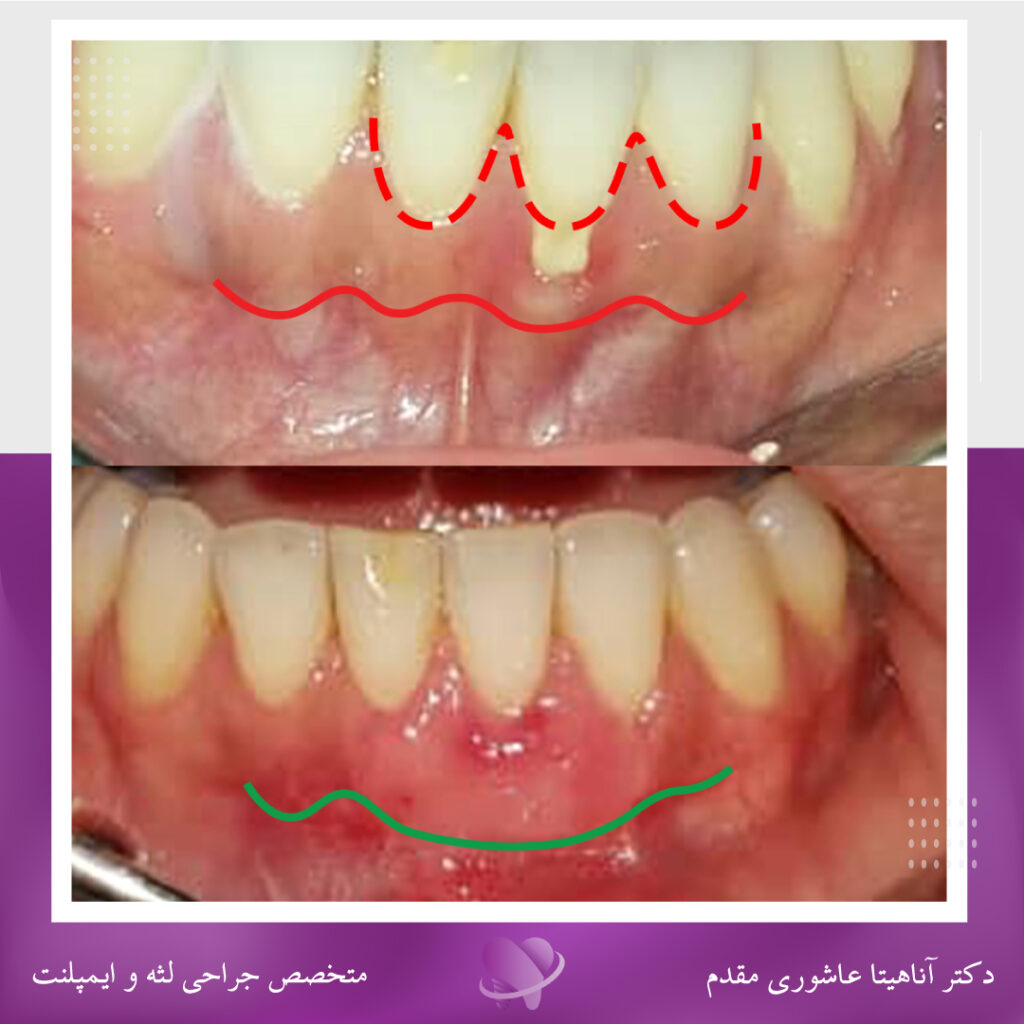 جراحی پیوند و تحلیل لثه در رشت