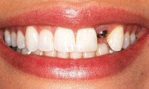 ایمپلنت فوری دندان + مراحل + مزایا و معایب - خبرخوان تی شین
