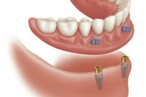 مزایا و معایب ایمپلنت دندان: آیا این روش برای شما مناسب است؟