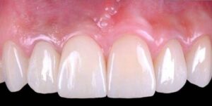 ایمپلنت فوری دندان + مراحل + مزایا و معایب - خبرخوان تی شین
