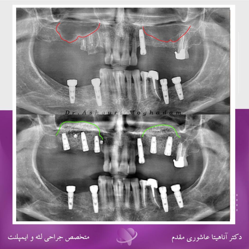 جراحی ایمپلنت در رشت